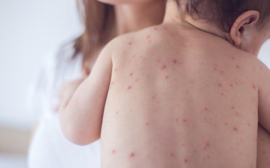 Peste 120 de copii din județ, bolnavi de varicelă. În ce școală sunt cele mai multe cazuri